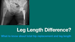 Ortho Glass Splinting Long Leg Posterior [upl. by Annirak991]