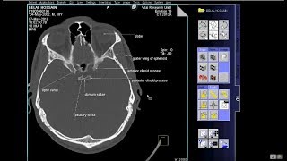 how to read ct scan of Skull bony window With Text [upl. by Nylidnam]