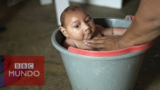 Zika ¿Cómo es la vida del bebé con microcefalia de esta famosa foto [upl. by Ellak]