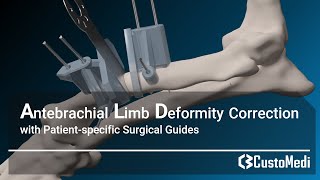 Antebrachial limb deformity correction with patientspecific surgical guides [upl. by Verada637]