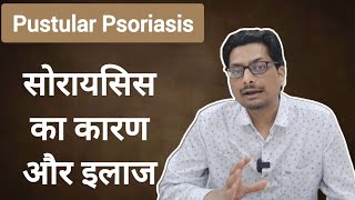 Pustular Psoriasis  सोरायसिस का कारण और इलाज़ psoriasis psoriasistreatment psoriasissolution [upl. by Rhodes614]