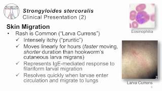 Helminths Strongyloides [upl. by Anilosi]