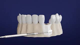 Step by Step Guide to Your Dental Implant Procedure [upl. by Adnovad]