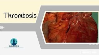 Thrombosis Part 2Morphology Fate amp Clinical Presentation of Thrombosis [upl. by Latimer154]