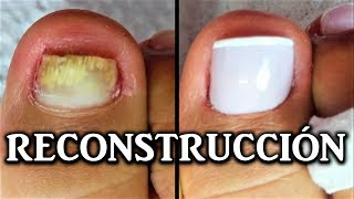 reconstruccion de uñas de pies con acrilico  nail reconstruction  reconstrução de unhas acrílico [upl. by Mervin]