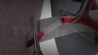 Parachute arterial anastomosis technique [upl. by Leemaj246]