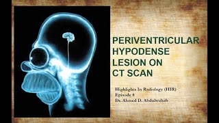 Periventricular hypodense lesions on CT scan Highlights In Radiology Episode 8 [upl. by Thin]