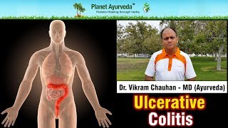 Ulcerative colitis Treatment  Dr Vikram Chauhan  MD Ayurveda [upl. by Rosol850]