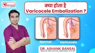 Varicocele Embolization in hindi Treatment for Varicoceles  Dr Ashank Bansal [upl. by Imoyik]