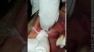 A demonstration of parotid papilla by Dr Nadeem Ahmed [upl. by Abbye]