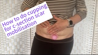 How to do cupping for csection scar mobilisation csectionscar csectionrecovery csectionmom [upl. by Vikky997]