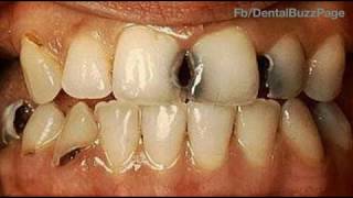 GV Blacks Classification of Dental Caries [upl. by Tjaden]