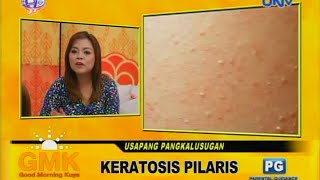 Keratosis Pilaris chicken skin [upl. by Rednas395]