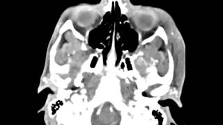 Mandibular Condyle Osteochondroma [upl. by Ttennej]