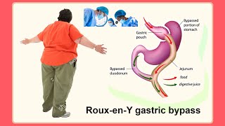 Roux en Y gastric bypass [upl. by Kosey679]