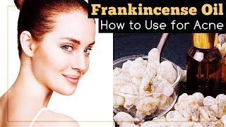 Frankincense Essential Oil for Acne How to Use It [upl. by Serrano]