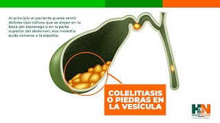 COLELITIASIS O PIEDRAS EN LA VESÍCULA [upl. by Aleel]