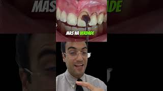 DENTES CURTOS drmiltonresponde [upl. by Edyak]