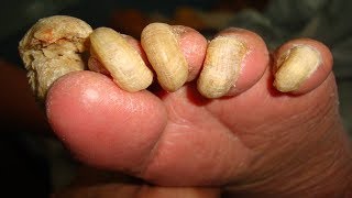 Home Remedies For Toenail Fungus That Work – CRUSH Nail Fungus Naturally [upl. by Adil541]