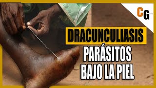 Dracunculiasis  El Parásito de 1 metro que habita bajo La Piel  El Gusano de Guinea EXPLICADO [upl. by Lilak509]