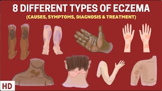 Eczema Exposed 8 Types You Need to Know [upl. by Palmore40]