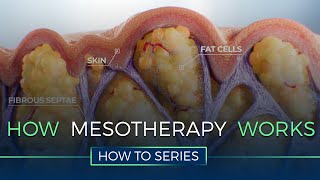 How Mesotherapy Works  HOW TO SERIES [upl. by Yeclek]