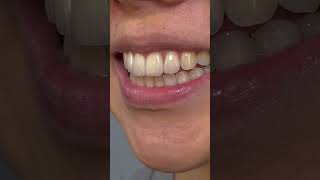 4 Veneers for this dentist patient readdescription veneers dental [upl. by Adnalram83]