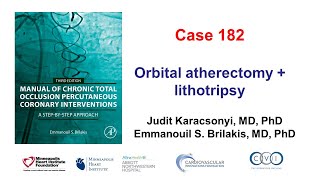 Case 182 Manual of CTO PCI  Orbital and rotational atherectomy [upl. by Enialem]