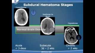 Traumatic Brain Injury Part 2 [upl. by Assirat]