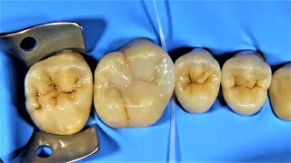 class 2 composite restoration amp Cusp Build Up of a Molar class2compositerestoration [upl. by Anaerdna]