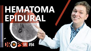 HEMATOMA EPIDURAL – COMO RECONHECER E PORQUE OCORRE [upl. by Arammahs]