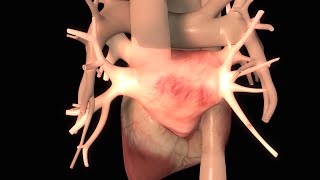 Effects of Congestive Heart Failure [upl. by Drusie]