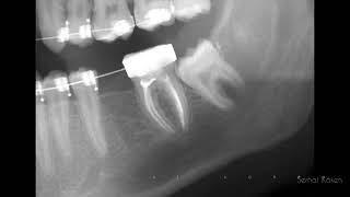 Mesialization of molar [upl. by Litta45]