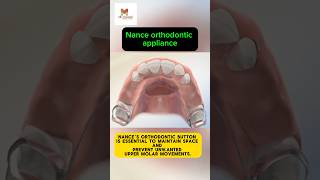 Nance Orthodontic Appliance  Braces  Orthodontics [upl. by Milas]