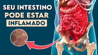 INTESTINO INFLAMADO Sintomas de Doença Inflamatória Intestinal │ Doença de Crohn [upl. by Annayk]