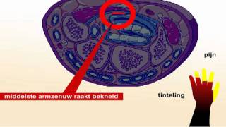 Carpaal Tunnel Syndroom CTS  Wat zijn de symptomen en behandeling van CTS [upl. by Airbas]