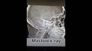 mastoid x ray ear x ray radiology shortvideo [upl. by Gnik]