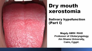 Dry mouth xerostomia Salivary hypofunction Part I [upl. by Girard]