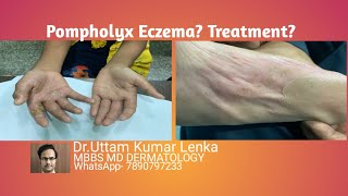 What is pompholyx eczema reason and Treatment of itchy vesiclesblisters on palms and soles [upl. by Rooker578]