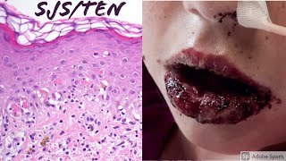 StevensJohnson SyndromeToxic Epidermal Necrolysis SJSTEN Spectrum [upl. by Vrablik657]