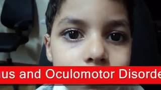 Intermittent Exotropia  الحول الوحشي المتقطع [upl. by Atsirt]