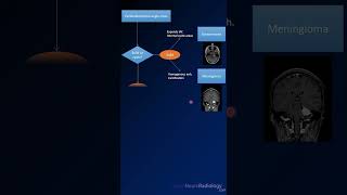 Imaging differential for Cerebellopontine Angle CPA masses radiology MRI tumors [upl. by Annodahs685]