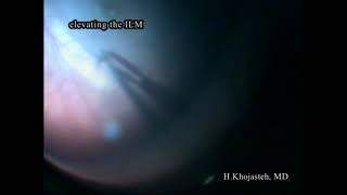 ILM flap in treatment of idiopathic full thickness macular hole  Supplementary video ID 236169 [upl. by Jarek129]