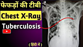 TuberculosisTB Active Chest X Ray Chest XRay Normal Vs Abnormal Chest X Ray in Hindi UdayXray [upl. by Arahset436]