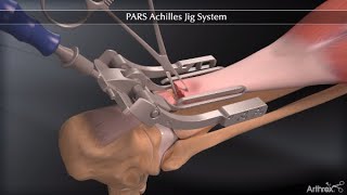 PARS Achilles Jig System [upl. by Quinby]