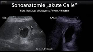 DProbleme Gallenblase und wege Worauf bd fokussierten Sonographie achten von Claudia Schrader [upl. by Akineg]