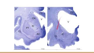 Huntington Disease Neuropathology Lecture [upl. by Egroej307]