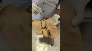 LIVERQuadrate ampCaudate Lobes shorts anatomy shortsyoutubeindia shortsyoutube liver hepatic [upl. by Alban]