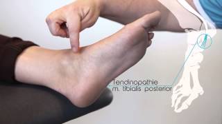 Tendinopathie m tibialis posterior [upl. by Lienahs]