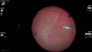 Removing a diabetic vitreous hemorrhage with modest traction off of the optic nerve [upl. by Avirt]